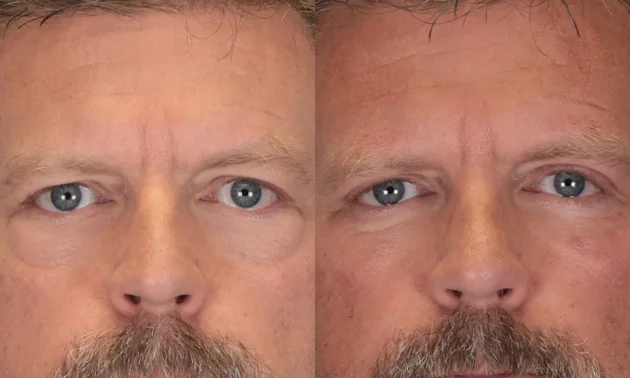 Real patient results in New York, NY Performed by Sameer Halani, MD
