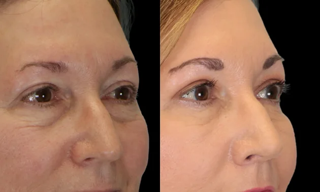 Real patient results in New York, NY Performed by Sameer Halani, MD