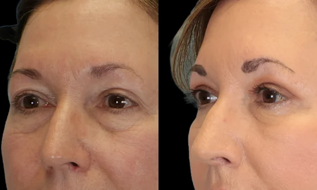 Real patient results in New York, NY Performed by Sameer Halani, MD