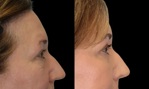 Real patient results in New York, NY Performed by Sameer Halani, MD