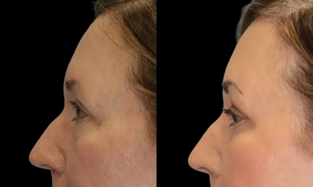 Real patient results in New York, NY Performed by Sameer Halani, MD