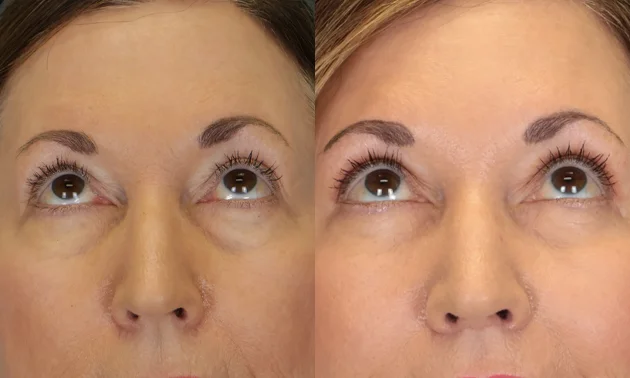 Real patient results in New York, NY Performed by Sameer Halani, MD