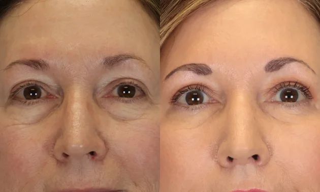 Real patient results in New York, NY Performed by Sameer Halani, MD