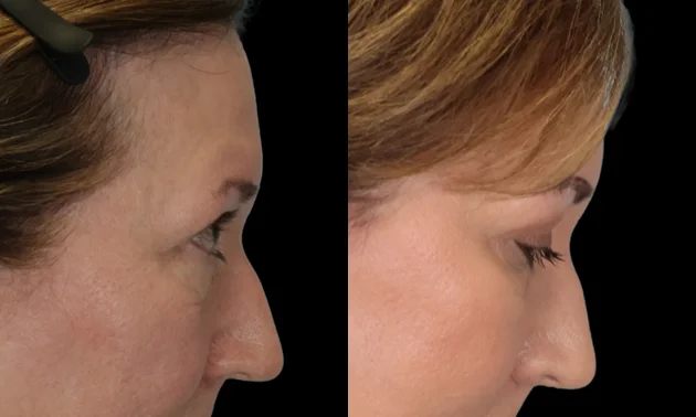 Real patient results in New York, NY Performed by Sameer Halani, MD