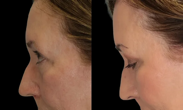 Real patient results in New York, NY Performed by Sameer Halani, MD