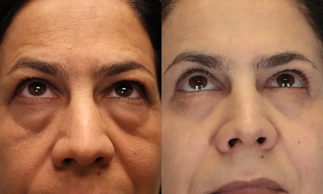 Real patient results in New York, NY Performed by Sameer Halani, MD