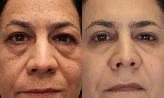 Real patient results in New York, NY Performed by Sameer Halani, MD