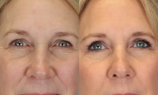 Real patient results in New York, NY Performed by Sameer Halani, MD