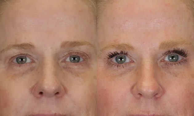 Real patient results in New York, NY Performed by Sameer Halani, MD