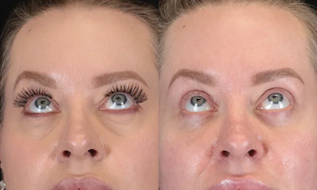 Real patient results in New York, NY Performed by Sameer Halani, MD