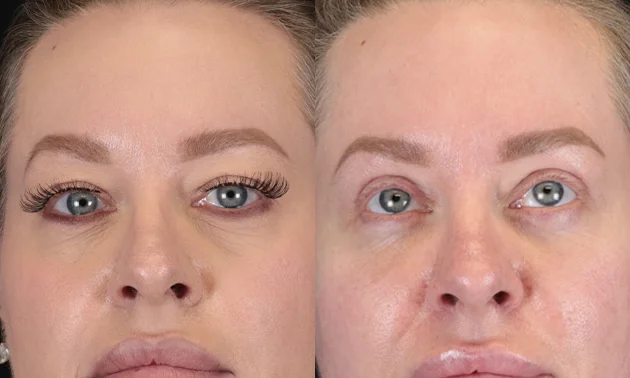 Real patient results in New York, NY Performed by Sameer Halani, MD