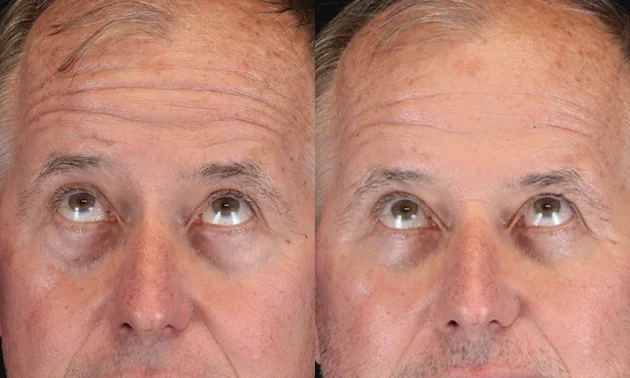 Real patient results in New York, NY Performed by Sameer Halani, MD