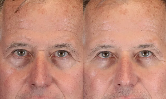 Real patient results in New York, NY Performed by Sameer Halani, MD