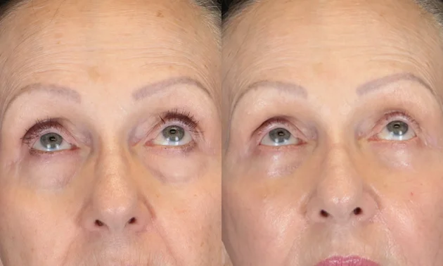Real patient results in New York, NY Performed by Sameer Halani, MD