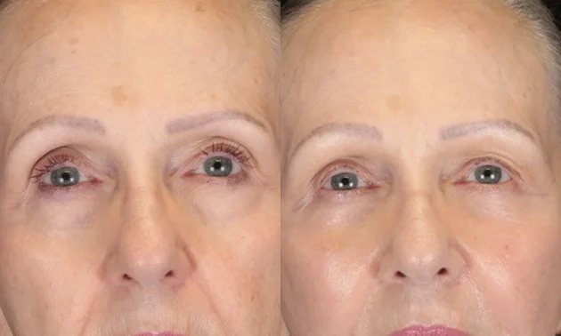 Real patient results in New York, NY Performed by Sameer Halani, MD