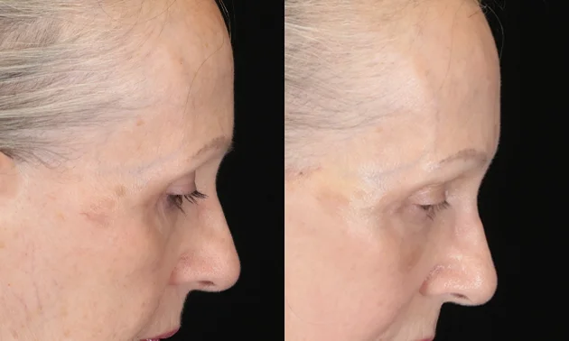 Real patient results in New York, NY Performed by Sameer Halani, MD
