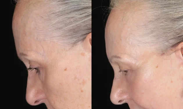 Real patient results in New York, NY Performed by Sameer Halani, MD