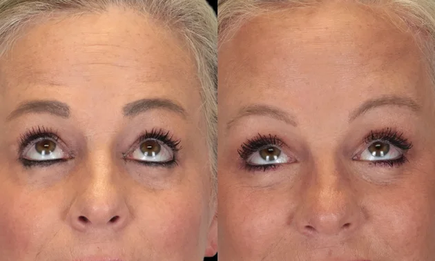 Real patient results in New York, NY Performed by Sameer Halani, MD