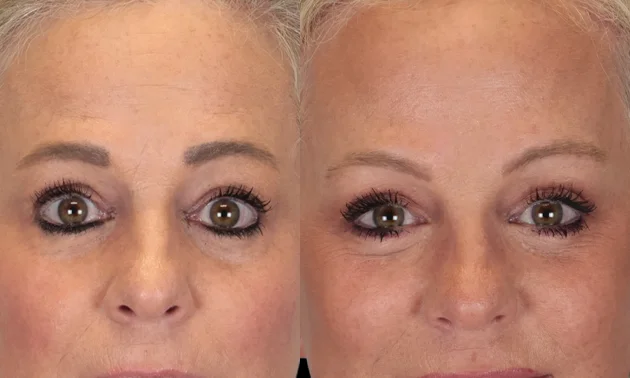 Real patient results in New York, NY Performed by Sameer Halani, MD