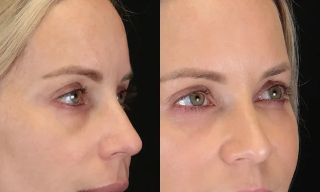 Real patient results in New York, NY Performed by Sameer Halani, MD