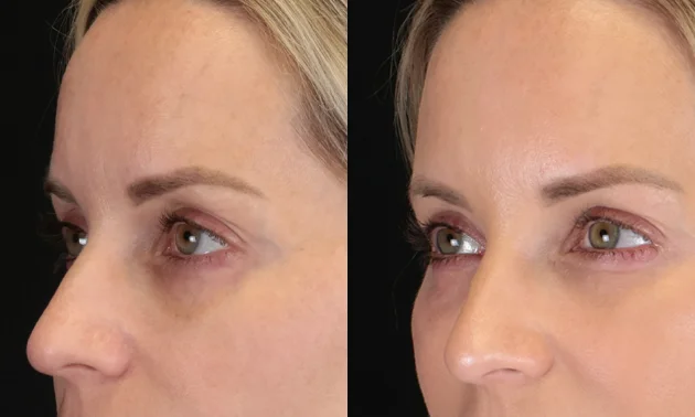 Real patient results in New York, NY Performed by Sameer Halani, MD