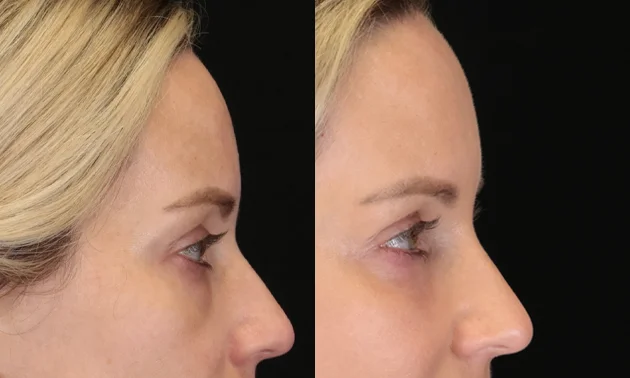 Real patient results in New York, NY Performed by Sameer Halani, MD