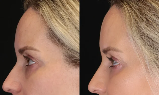 Real patient results in New York, NY Performed by Sameer Halani, MD
