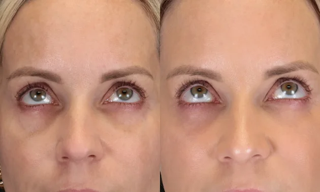 Real patient results in New York, NY Performed by Sameer Halani, MD