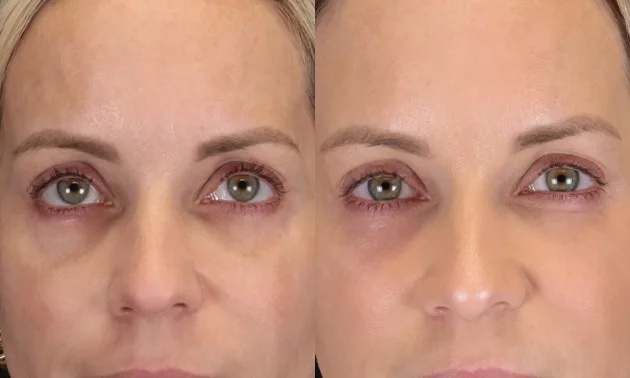 Real patient results in New York, NY Performed by Sameer Halani, MD