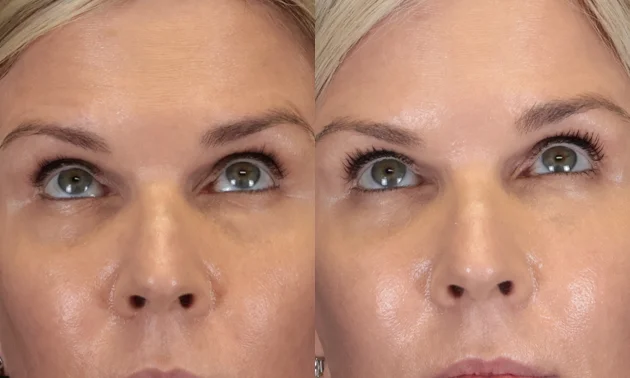 Real patient results in New York, NY Performed by Sameer Halani, MD