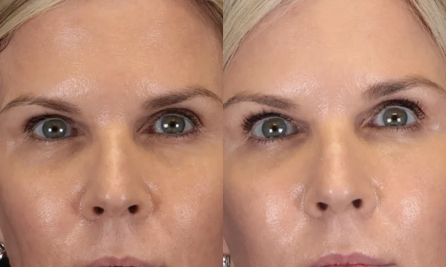 Real patient results in New York, NY Performed by Sameer Halani, MD
