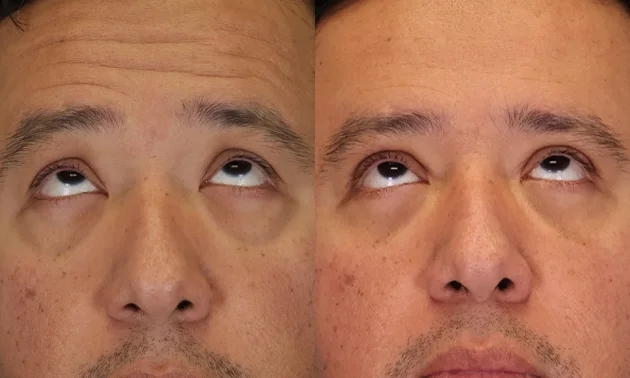 Real patient results in New York, NY Performed by Sameer Halani, MD