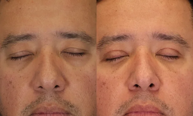 Real patient results in New York, NY Performed by Sameer Halani, MD