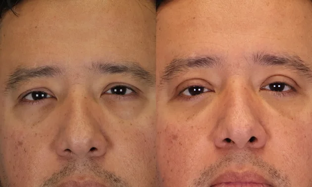 Real patient results in New York, NY Performed by Sameer Halani, MD