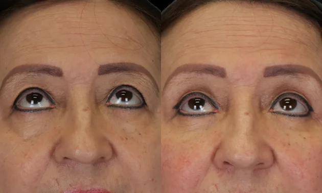 Real patient results in New York, NY Performed by Sameer Halani, MD