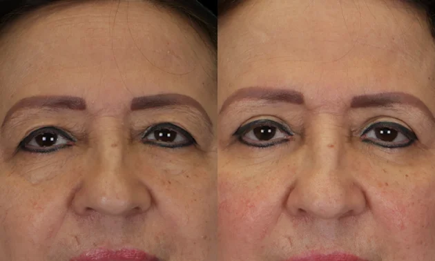 Real patient results in New York, NY Performed by Sameer Halani, MD