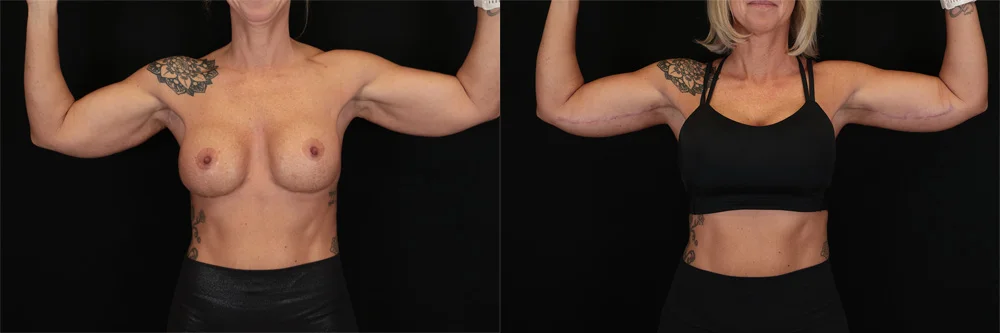 Real patient results in New York, NY Performed by Sameer Halani, MD