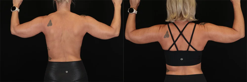 Real patient results in New York, NY Performed by Sameer Halani, MD