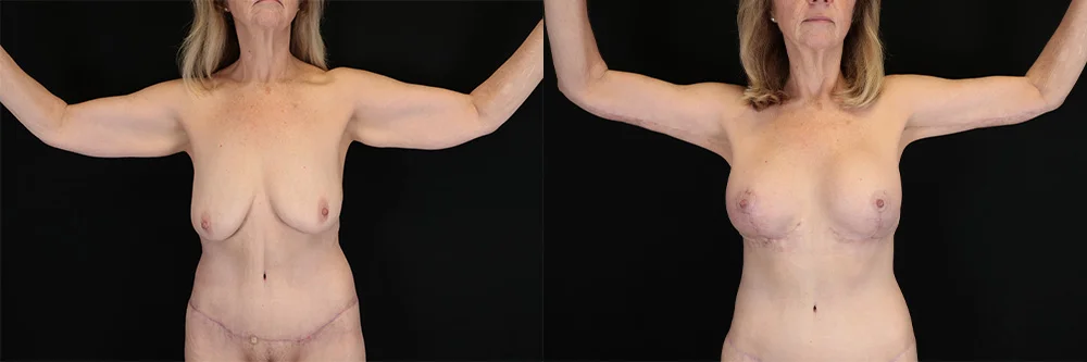 Real patient results in New York, NY Performed by Sameer Halani, MD