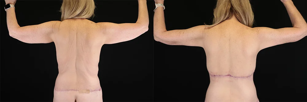 Real patient results in New York, NY Performed by Sameer Halani, MD