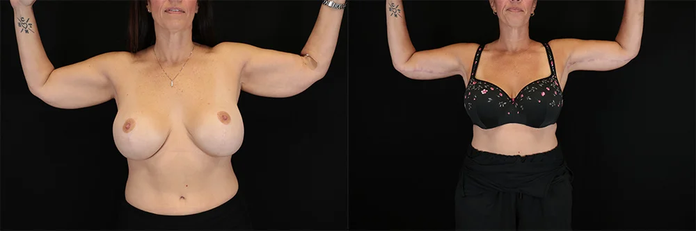 Real patient results in New York, NY Performed by Sameer Halani, MD