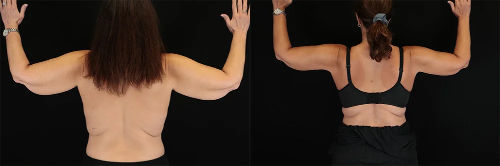 Real patient results in New York, NY Performed by Sameer Halani, MD