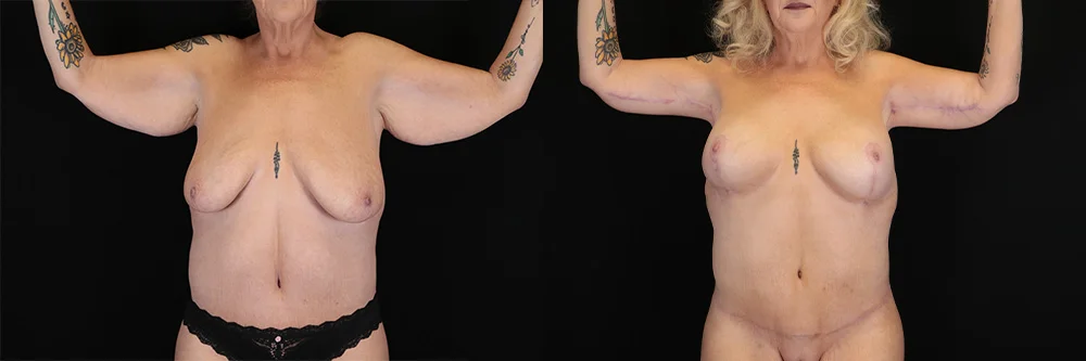 Real patient results in New York, NY Performed by Sameer Halani, MD