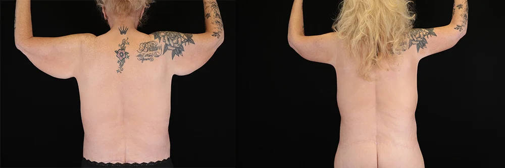 Real patient results in New York, NY Performed by Sameer Halani, MD