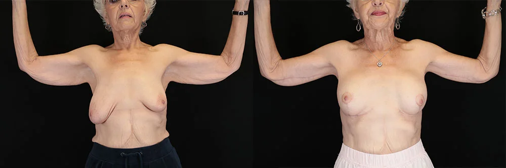 Real patient results in New York, NY Performed by Sameer Halani, MD