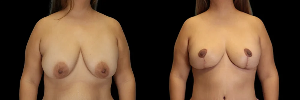 Real patient results in New York, NY Performed by Sameer Halani, MD