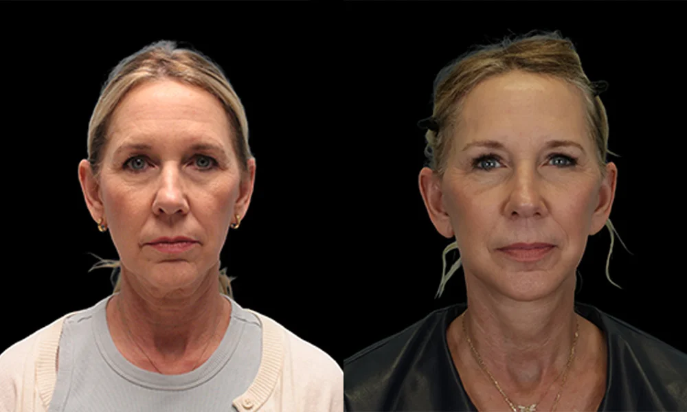 Real patient results in New York, NY Performed by Sameer Halani, MD