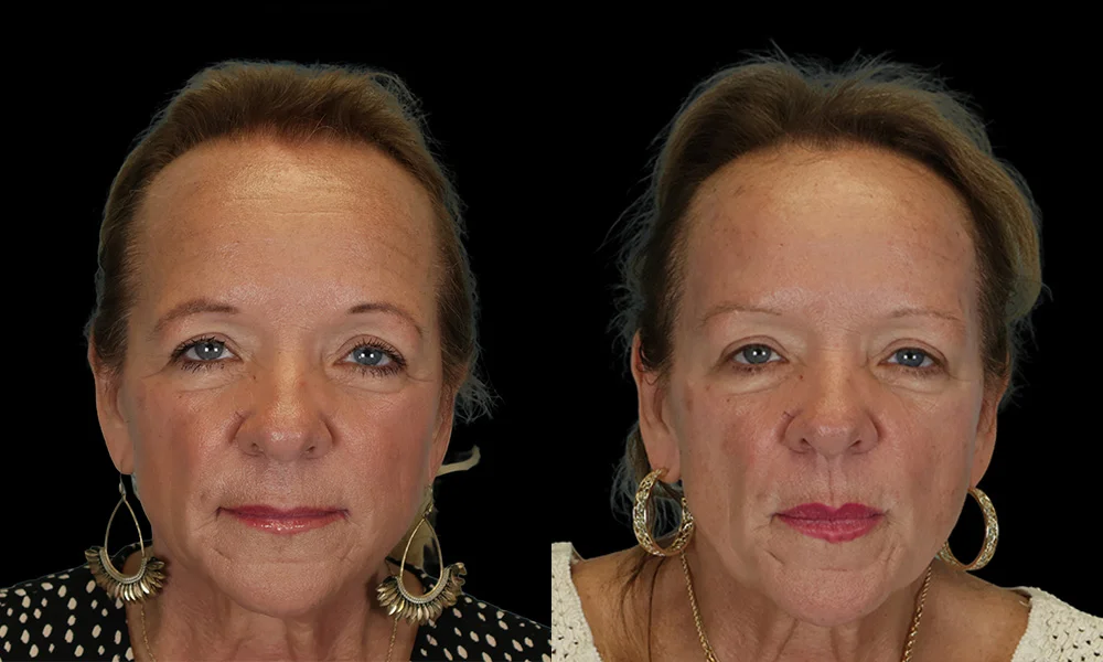Real patient results in New York, NY Performed by Sameer Halani, MD