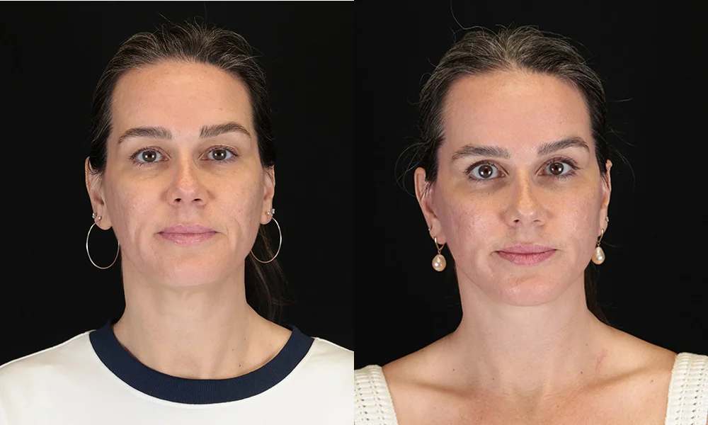 Real patient results in New York, NY Performed by Sameer Halani, MD