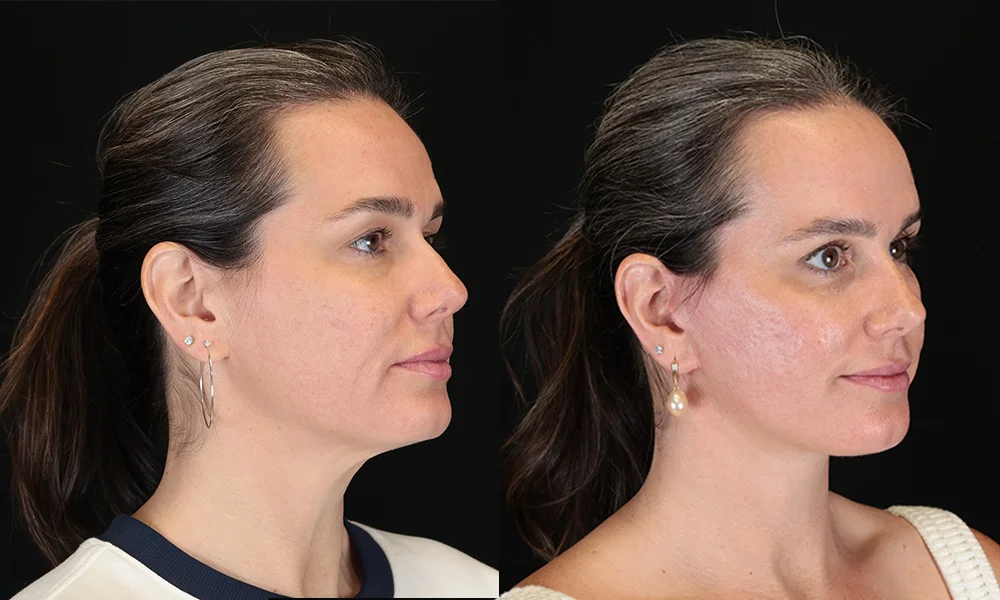 Real patient results in New York, NY Performed by Sameer Halani, MD